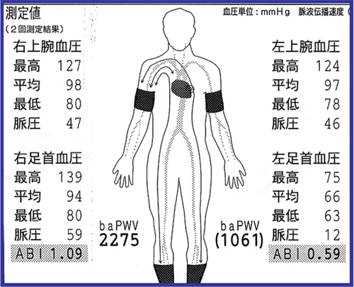 下肢・上腕血圧比（ABI）測定検査