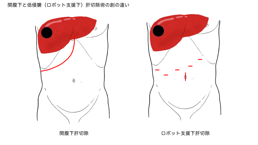図3.開腹下と低侵襲肝切除術の創の違い