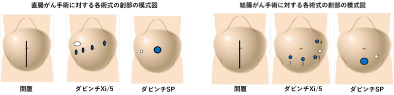 ロボット支援下大腸切除 | 専門領域のご案内 | 東京医科大学 消化器